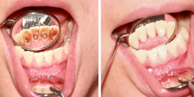 How to Remove Tartar From Teeth Without Dentist