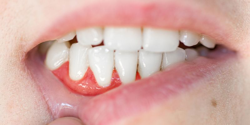 How to Get Rid of a Tooth Abscess Without Going to the Dentist